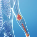 cinema 4d rendering of Human arm bone hyperplasia